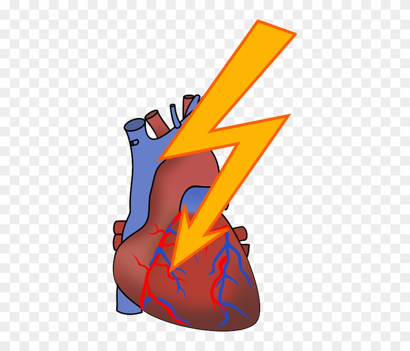 Health Arrhythmia, Heart Attack, Cardiac, Coronary, - Cardiac Arrhythmia Clip Art #1125043