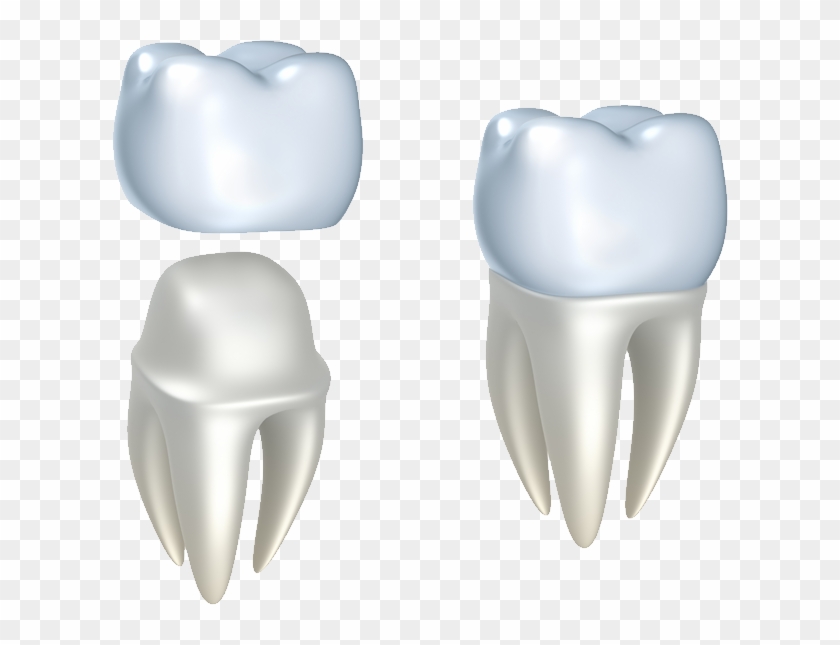 Restoring Your Smile - Dental Crowns Png #1165728