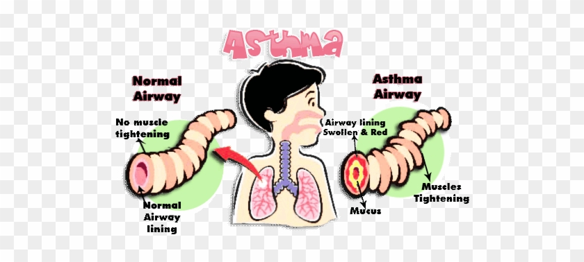 Treatment Clipart Asthma Attack - Omega 3 And Asthma #1175278