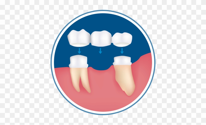 Dental Bridges - Clear Aligners #1176316