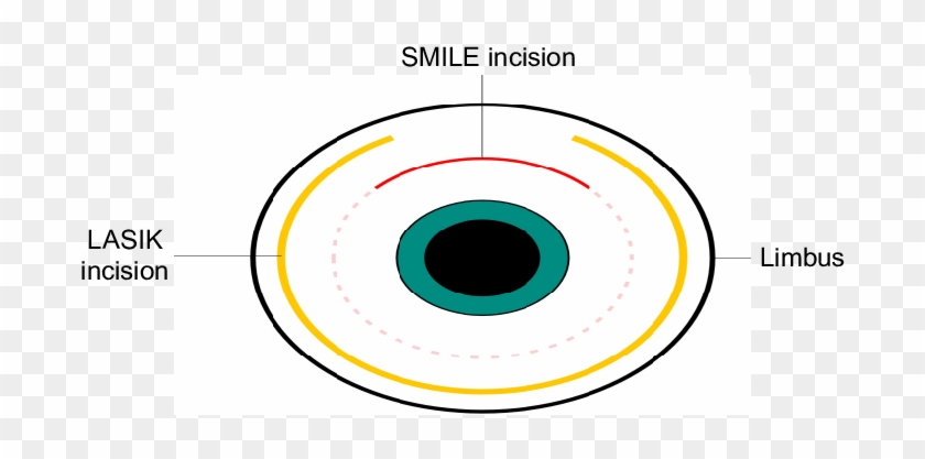 Schematic Representation Of Smile Incision And Lasik - Circle #1198151