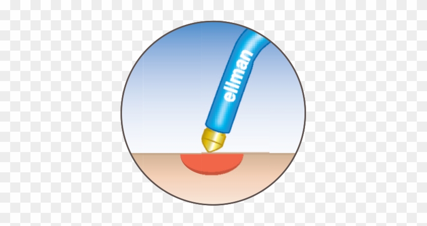 Hemostasis With Controlled Penetraction - Maroussi Bc #1198206