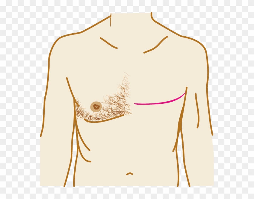 It Involves Removing All The Breast Tissue Including - Lymph Nodes Male Breast #1202075