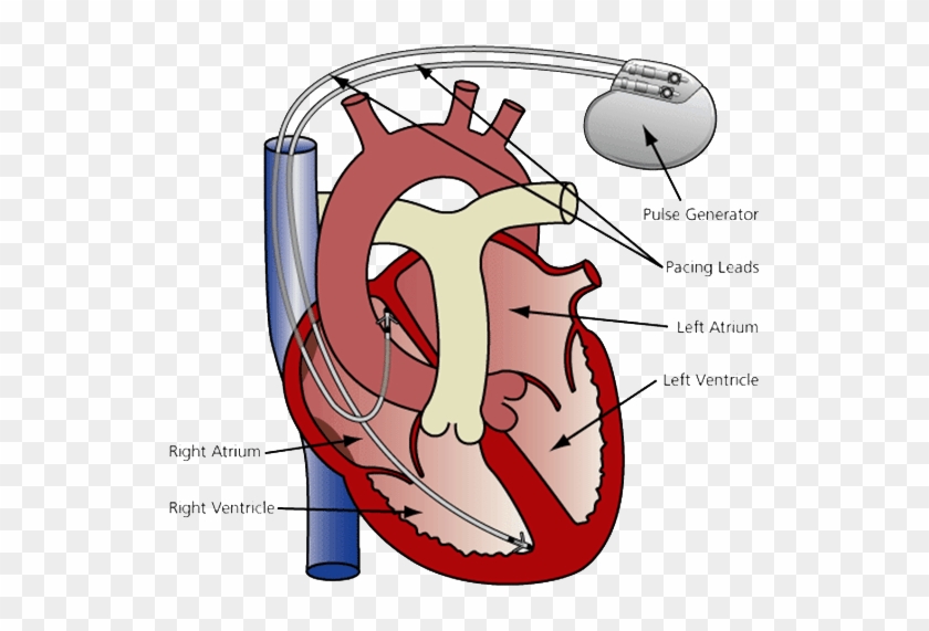 Rate Clipart Triple Heart - Pacemaker In The Heart #1226429