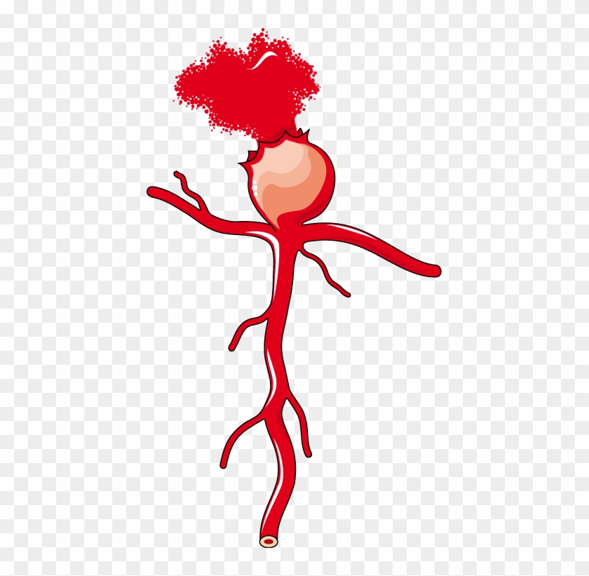 Saccular Aneurysm - Erythropoiesis #197184