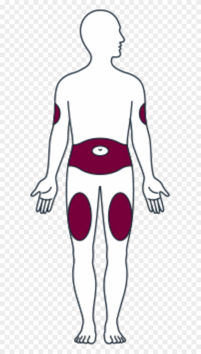 Front Side Appropriate Injection Sites - Arm #197723