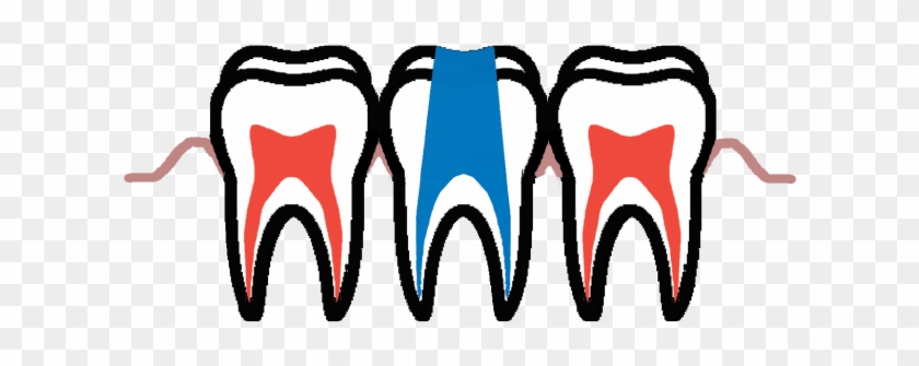 When Tooth Decay Reaches The Dental Pulp, Root Canal - When Tooth Decay Reaches The Dental Pulp, Root Canal #1293929