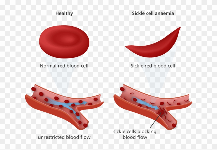 The Sickle Blood Cells Burst More Quickly Than Others - Sickle Cell Anemia Red Blood Cells #1294135