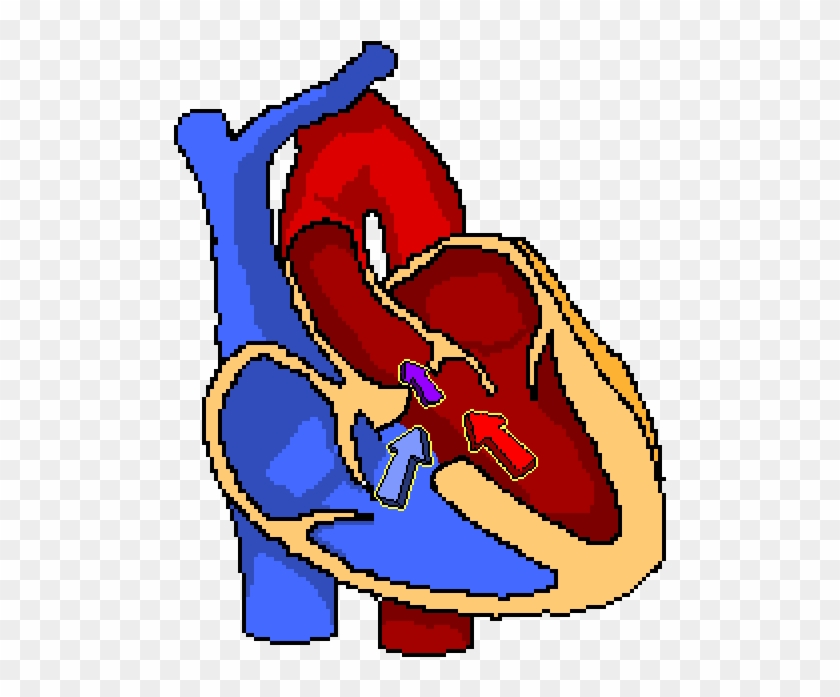 Ventricular Septal Defect #1305666