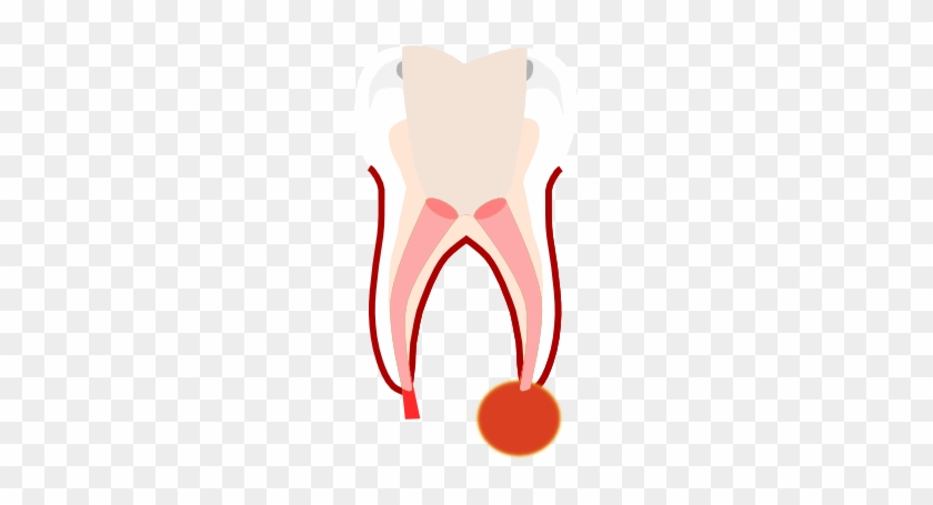 Preparation Of The Root Canals - Illustration #1308300