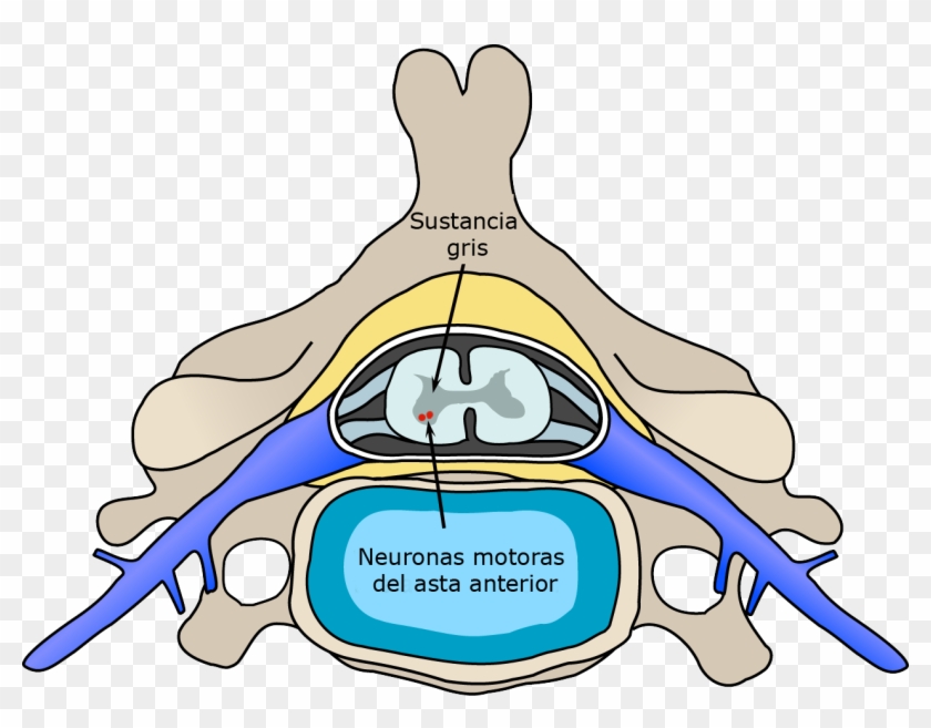 Polio Spinal Diagram Es - Polio Effect On Spinal Cord #1356349