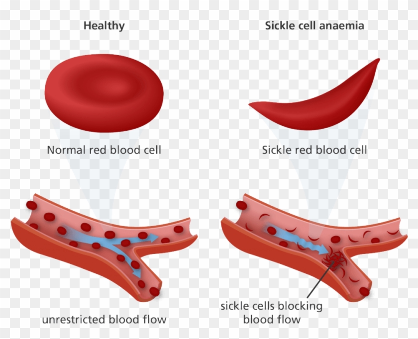 Multiple Myeloma Drug Could Revolutionize Treatment - Normal Red Blood Cell And Sickle Cell #1361981