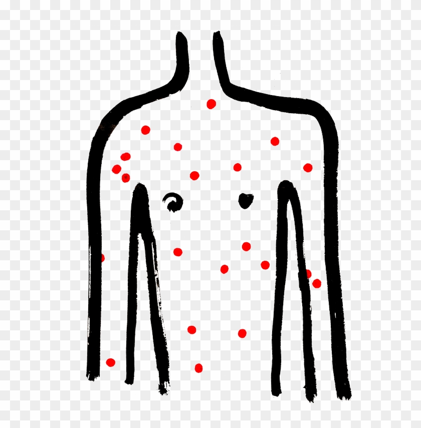 Chicken Pox - Chicken Pox #1373458