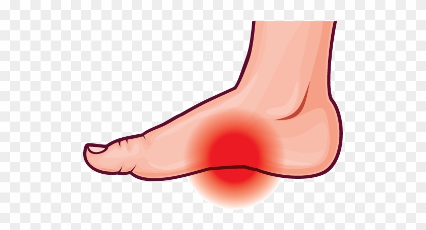 Arch Pain - Clip Art Foot Pain #216575