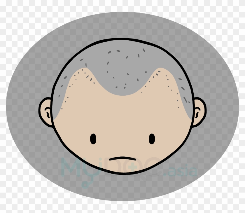 Clipart Free Stock Will I Be Like - Hair Loss #1402728