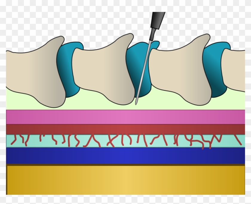 Download Epidural Needle In Back Clipart Back Pain - Znieczulenie Zewnątrzoponowe #1414709