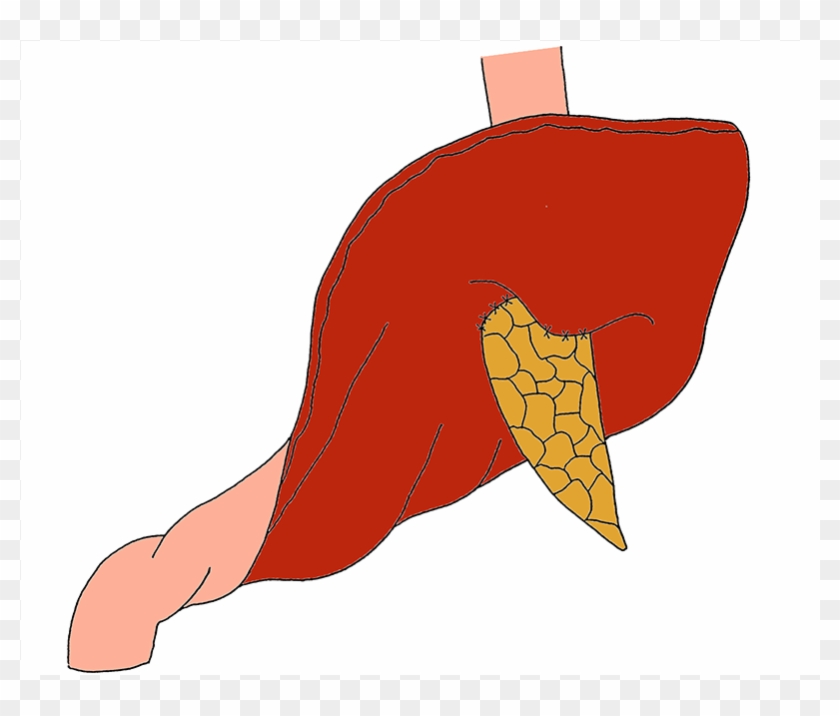 Outer Layer Is Performed Between The Pancreatic Capsule - Illustration #1429044