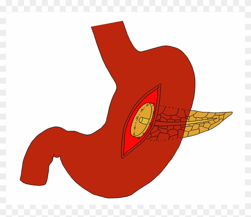 The Anterior Incision Is Closed Or The Clamp Is Replaced - Pancreas #1429054