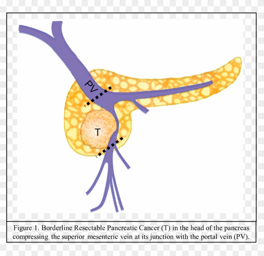 Outcome Of Patients With Borderline Resectable Pancreatic - Outcome Of Patients With Borderline Resectable Pancreatic #1429060