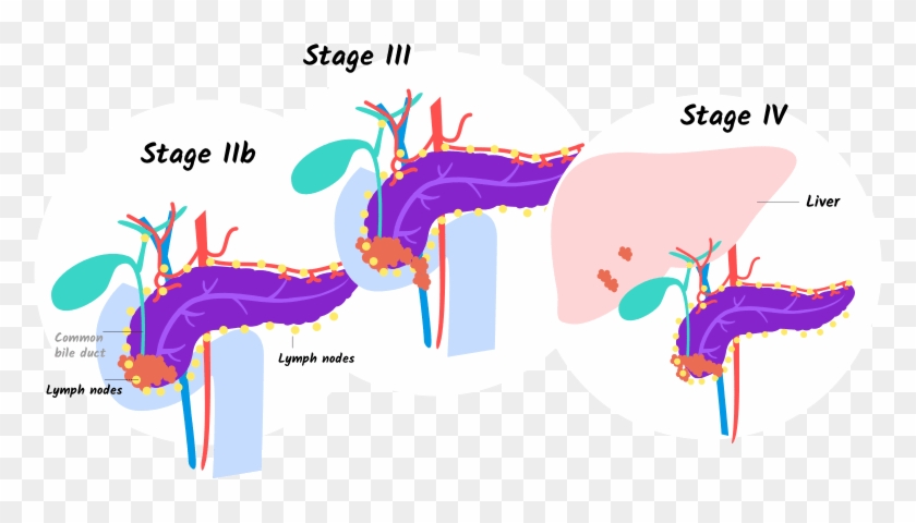 Illustration Of Stages Iib, Iii, And Iv Of Pancreatic - 4 Pancreatic Cancer Stages That Help You #1429066