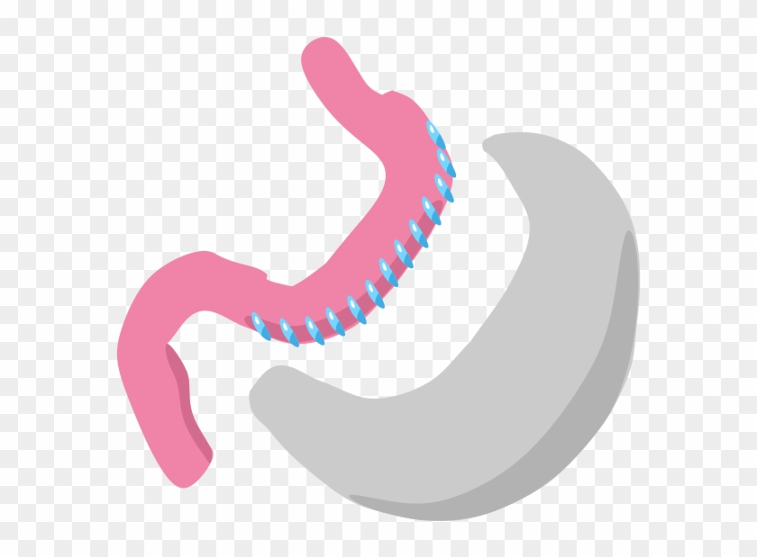 Complications - تكميم المعده #1434973