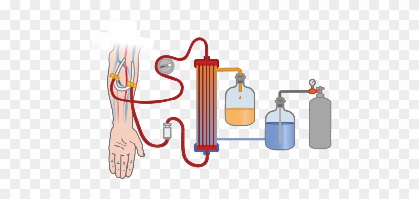 Operating On Patients On Dialysis What Are The Anaesthetic - Illustration #1437831