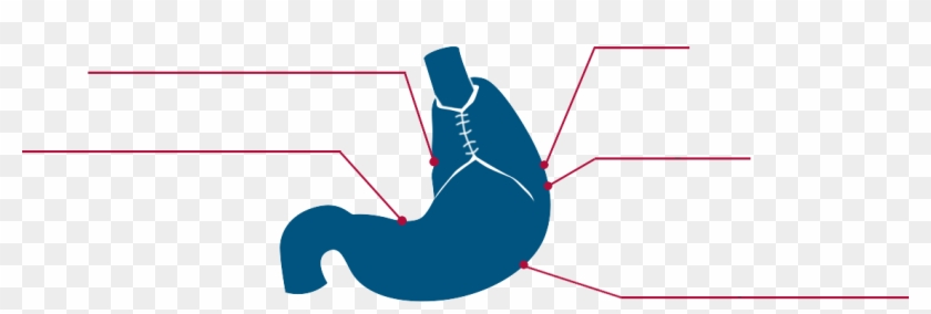 Gerd Gastroenterology Marina Del Rey Hospital Laparoscopic - Diagram #1439162