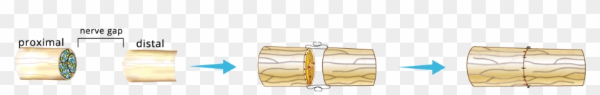 A Direct Repair May Be Done When There Is No Gap Between - Illustration #1445638