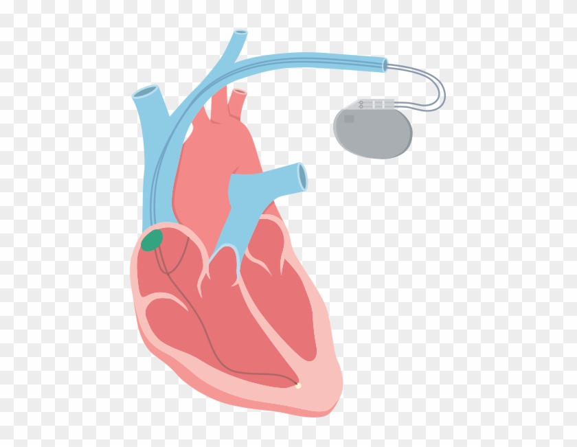 The Electrical Impulses Can Be Disrupted In Heart Muscle - Artificial Cardiac Pacemaker #1452163