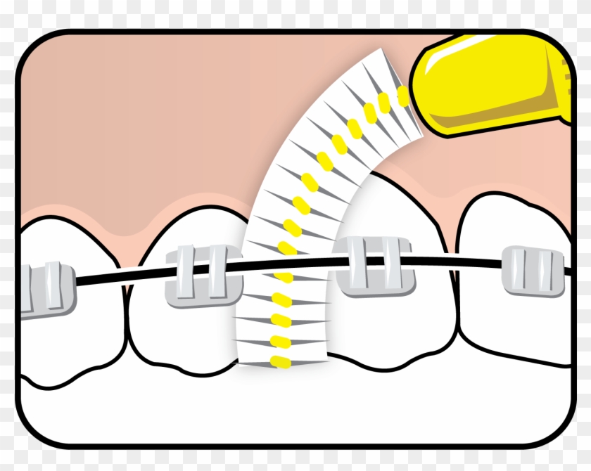 Tepe Interdental Brush™ On Braces - Tepe Interdental #1452251