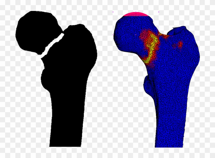 Example Of Femoral Fracture Prediction - Radboud University Medical Center #1455094