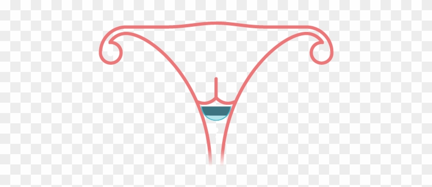 The Diaphragm Will Stop Sperm From Reaching An Egg - Thong #1457447