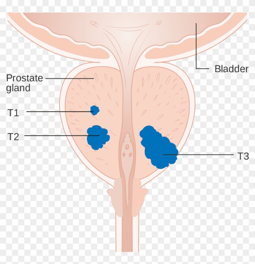 Prostate Cancer Affects Almost A Quarter Of A Million - Prostate #1462380