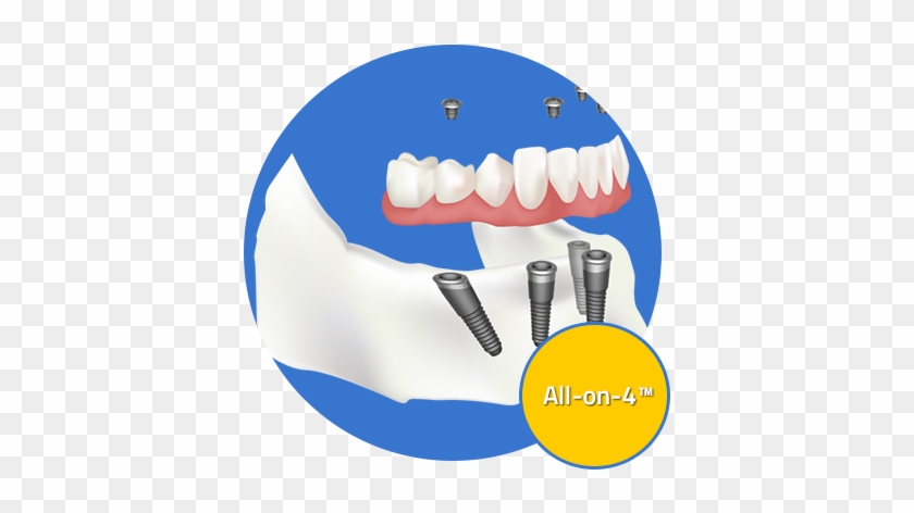Custom Dental Offers A Variety Of Dental Implant Options - All-on-4 #1470648