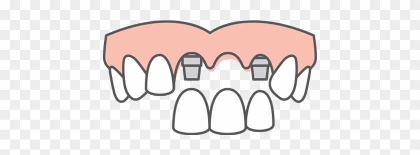 Multiple Tooth Replacement If You're Missing Several - Dental Implant Icons Png #1470651