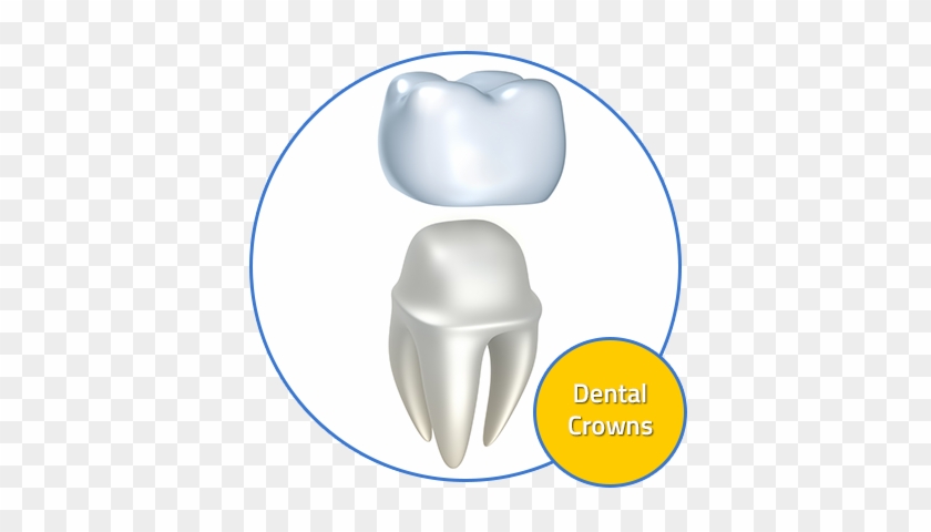 Custom Dental Offers Dental Crowns - Protesis Dental #1470664