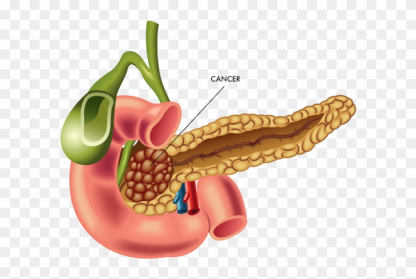 Tumors We Treat - Tumors We Treat #1524949