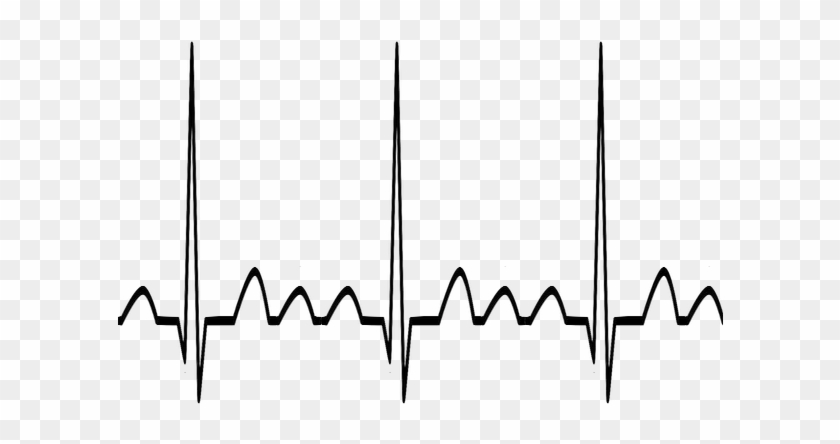 Supraventricular Tachycardia - Supraventricular Tachycardia #1529385