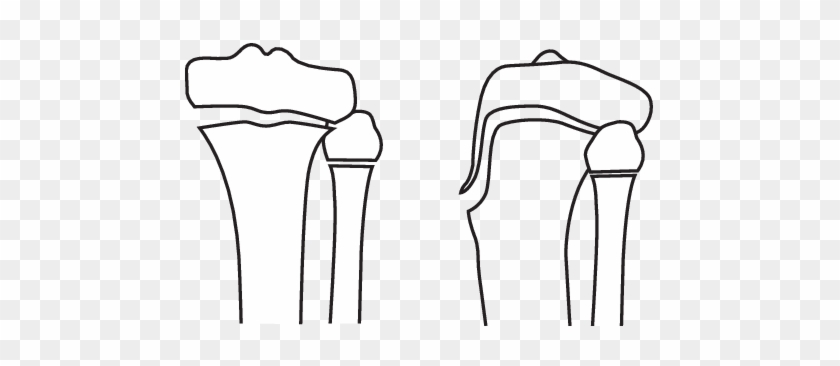 Schematic Diagram Demonstrating Our Type B Physeal - Schematic Diagram Demonstrating Our Type B Physeal #1531632