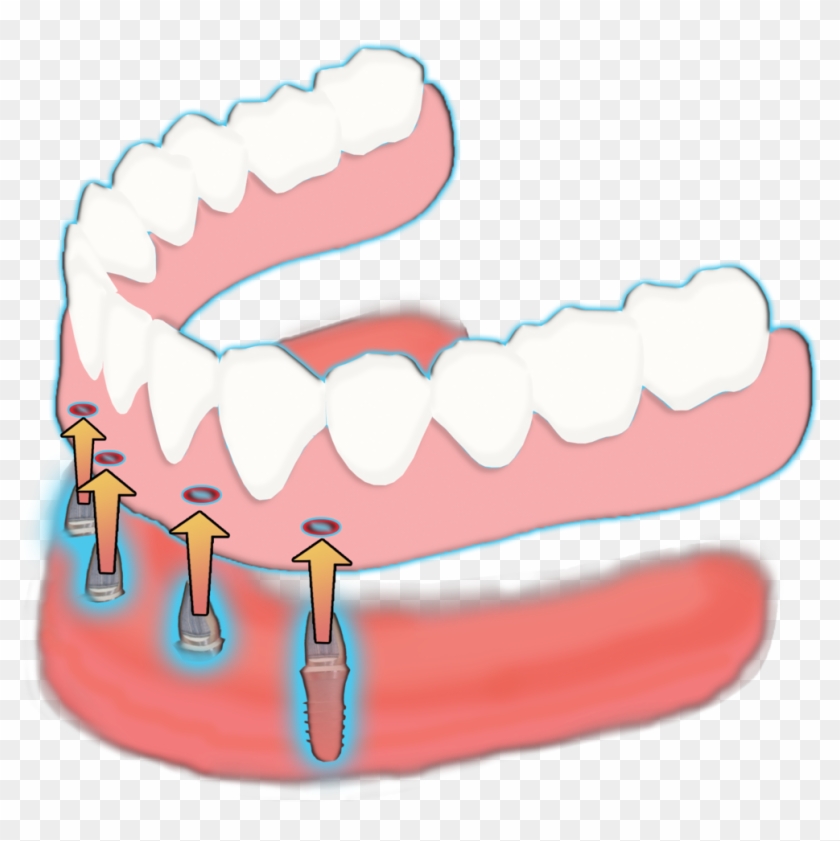 Dental Clipart Dentures - Dental Clipart Dentures #1532077