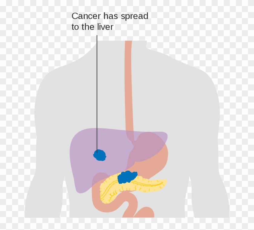 Liver-cancer - Liver-cancer #1538132