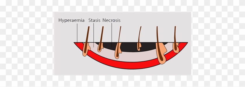 The Zones Of An Acute Burn Wound - The Zones Of An Acute Burn Wound #1551269
