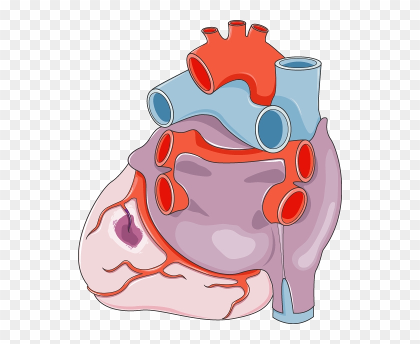 Infarctus Du Myocarde - Schéma D Un Infarctus #40333