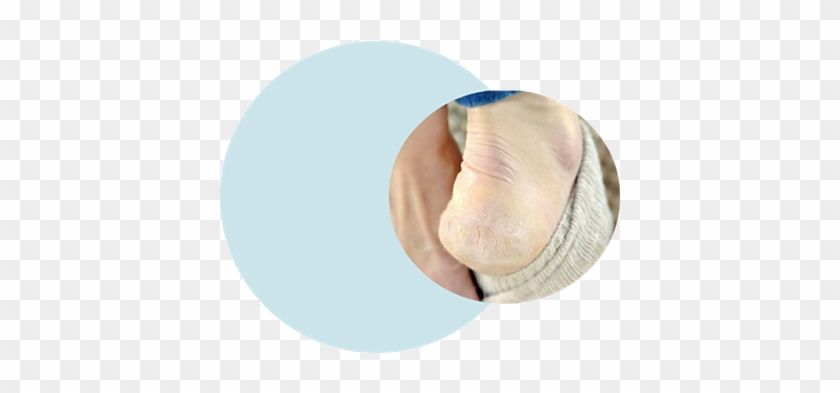 Blog The Causes Of Cracked Heels And Prevention Tips - Blog The Causes Of Cracked Heels And Prevention Tips #1560640