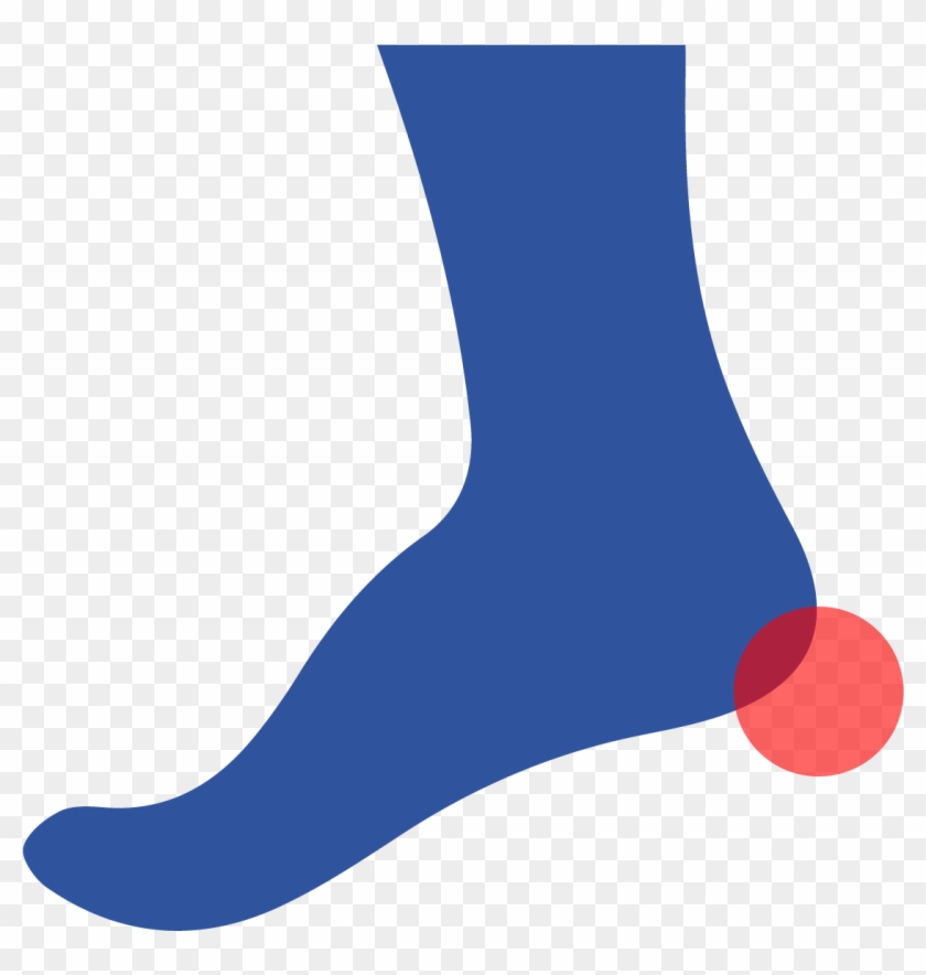 A Heel Spur Is A Calcium Deposit That Forms A Small - A Heel Spur Is A Calcium Deposit That Forms A Small #1562201
