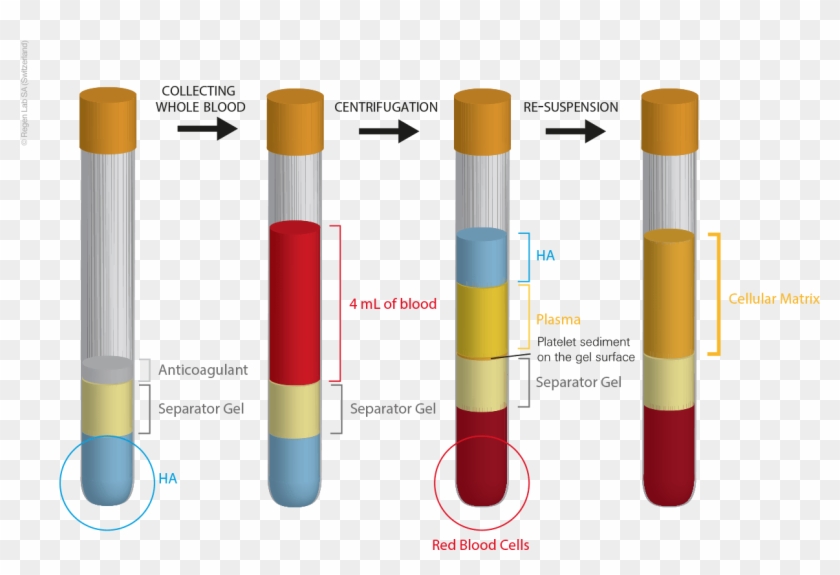 Platelet Rich Plasma Treatment - Platelet Rich Plasma Treatment #1562679