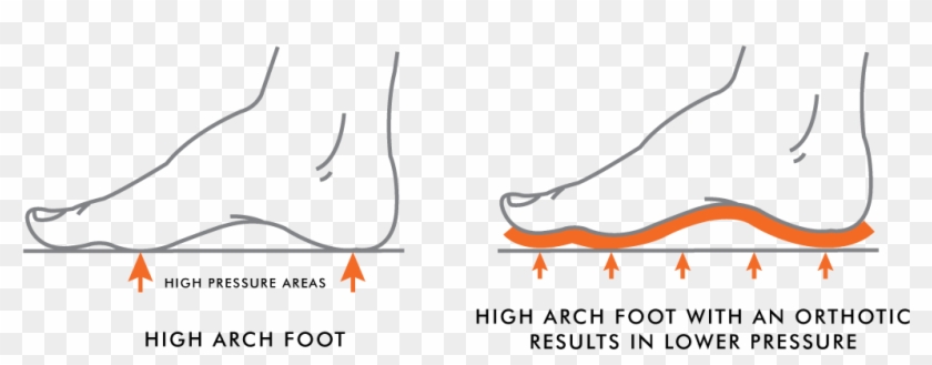 High Arches Vs Low Arches - High Arches Vs Low Arches #1583048