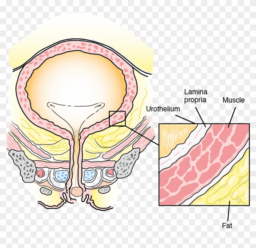 Patient Clipart Kidney Cancer - Patient Clipart Kidney Cancer #1583481