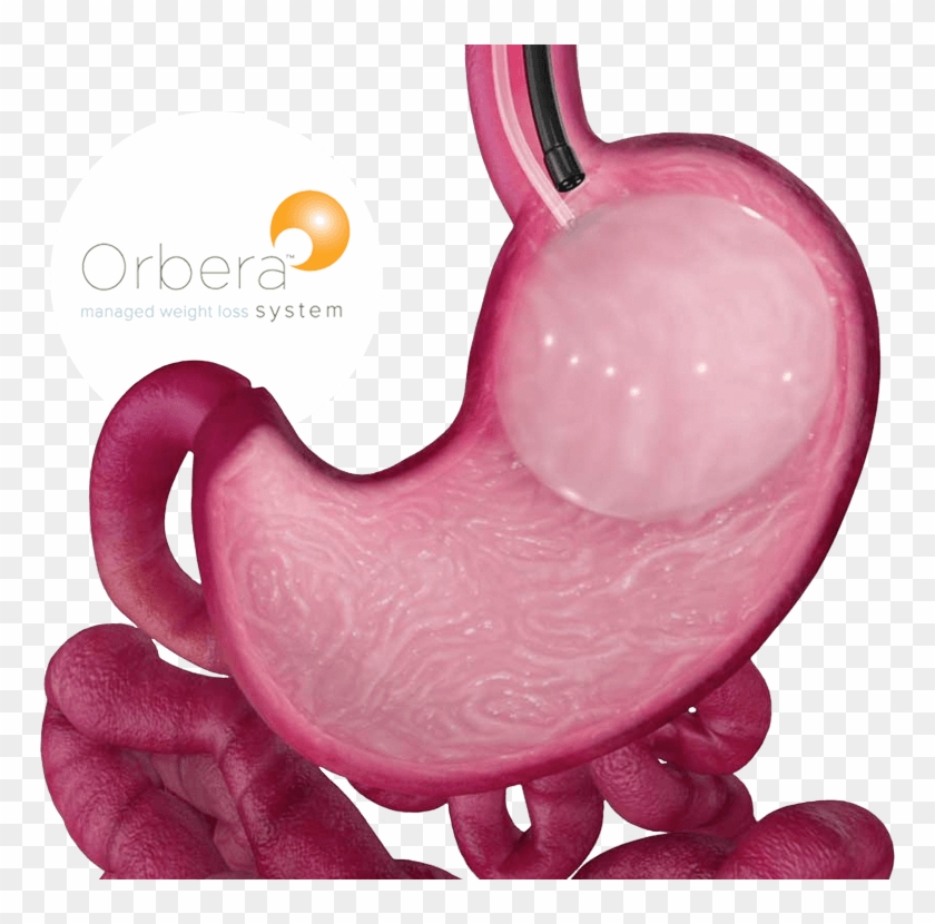 Now Offering Orbera - Gastric Balloon #1593119