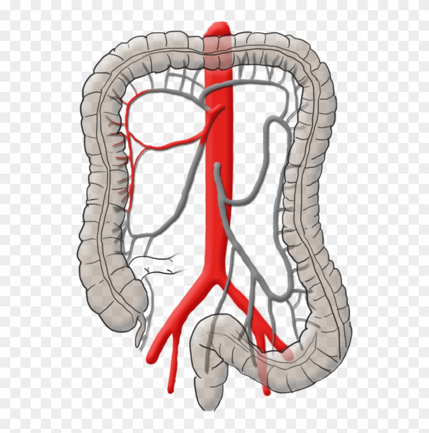 Mysurgery Carcinoma Right Colic - Operation Darmkrebs #1594142